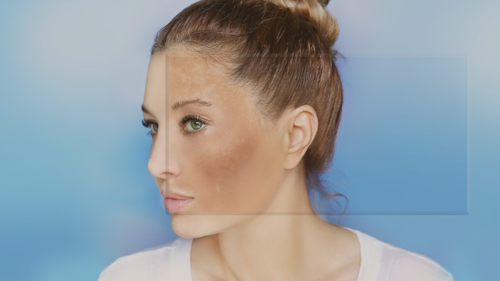 Melasma profundo: como identificar e tratar os casos mais difíceis