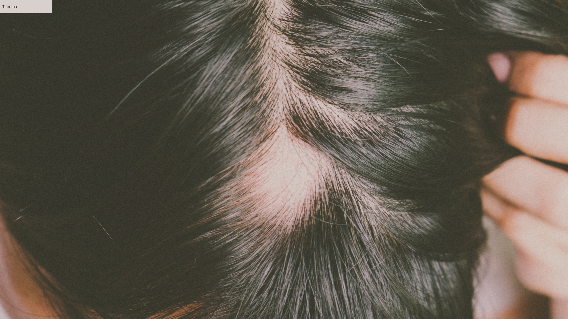 Alopecia Areata: O Que é ?