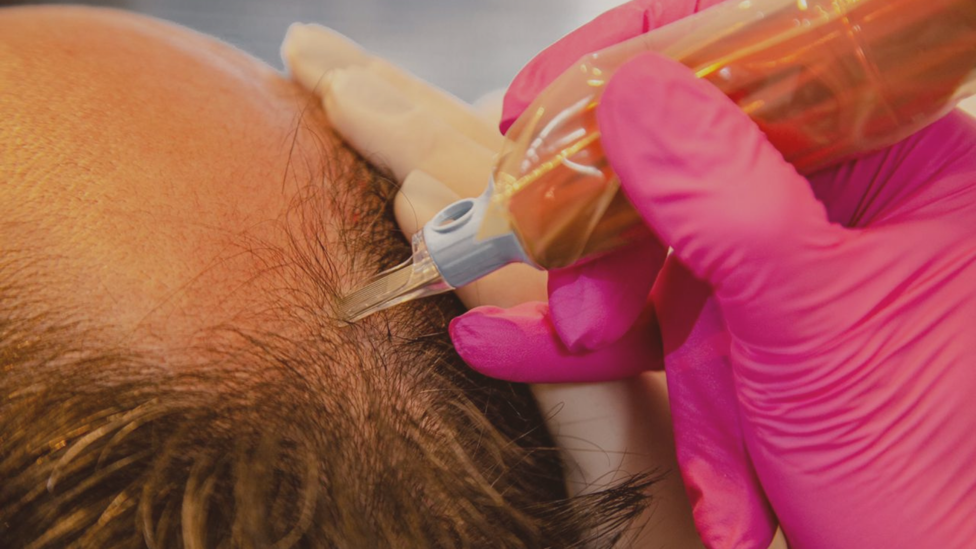 A queda de cabelo é uma das queixas mais frequentes em consultórios dermatológicos e estéticos. Homens e mulheres, cada vez mais cedo, têm buscado alternativas eficazes para tratar alopecia androgenética, eflúvio telógeno e outras formas de rarefação capilar.