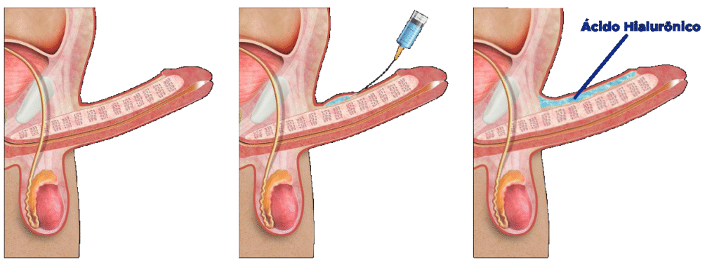 bioplastia filipe ferrara