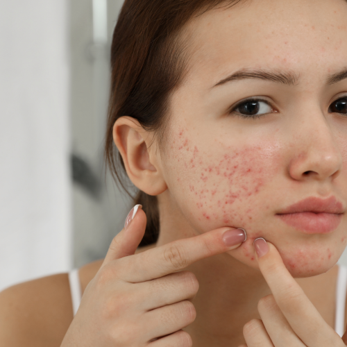 SOP e Acne: Entenda a Relação