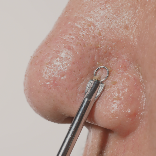 Limpeza de Pele: O Que é ?