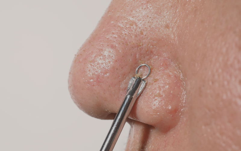 Limpeza de Pele: O Que é ?