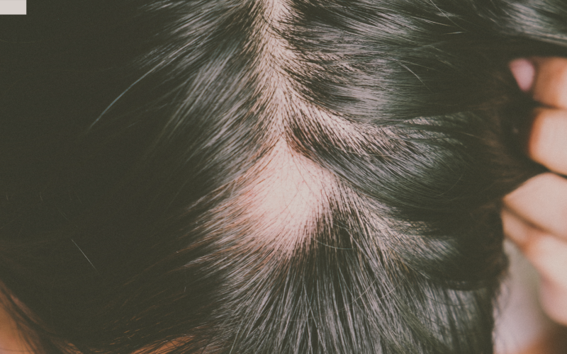 Alopecia Areata: O Que é ?
