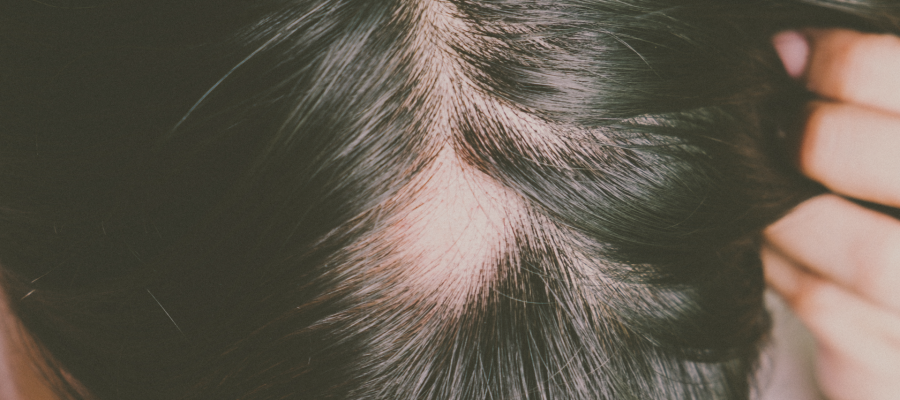Alopecia Areata: O Que é ?