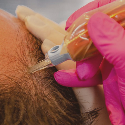 MMP no tratamento da queda de cabelo