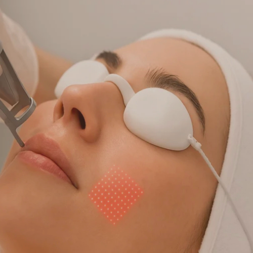 Laser de CO₂ : O Que é ?