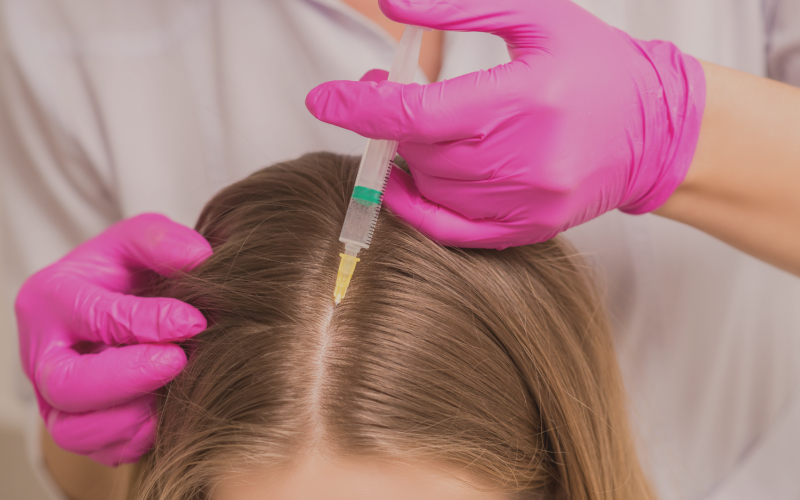 O que é Mesoterapia Capilar?