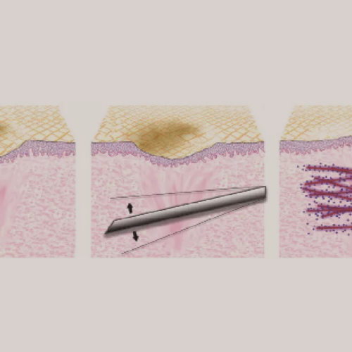 O que é Subincisão?