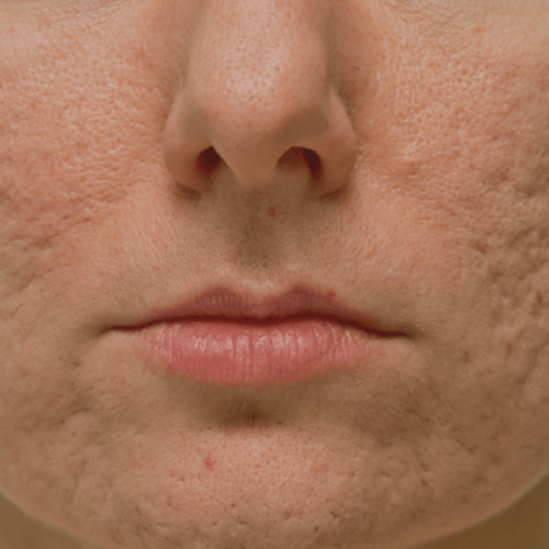 O que são Cicatrizes de Acne?