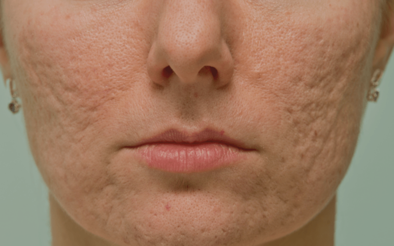 O que são Cicatrizes de Acne?