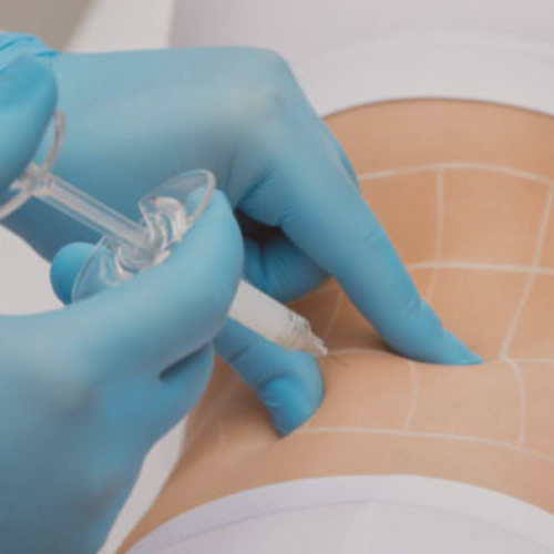 O que é Intradermoterapia para Gordura Localizada?