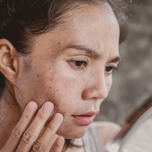 Como tratar o melasma: guia completo de cuidados e rotina para sua pele