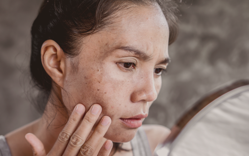 Melasma resistente: por que não clareia e o que realmente funciona