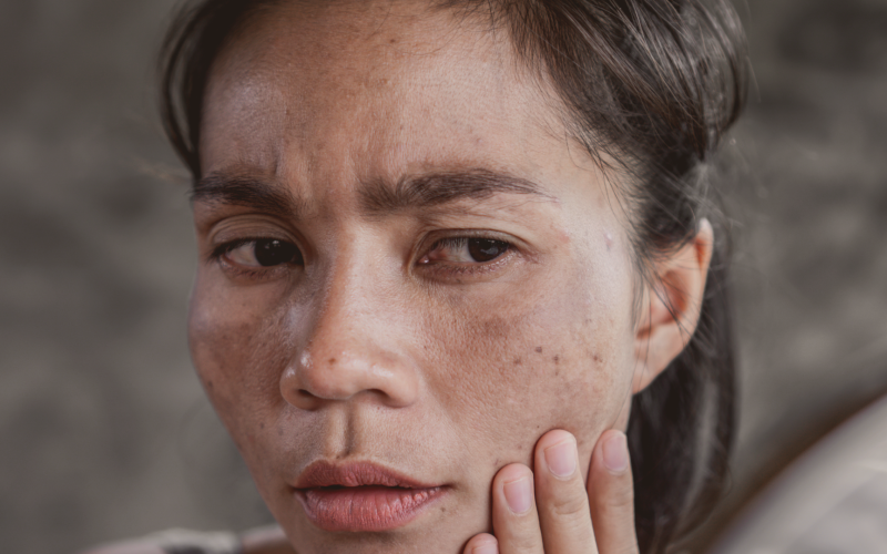 Melasma no Rosto: O Que É,