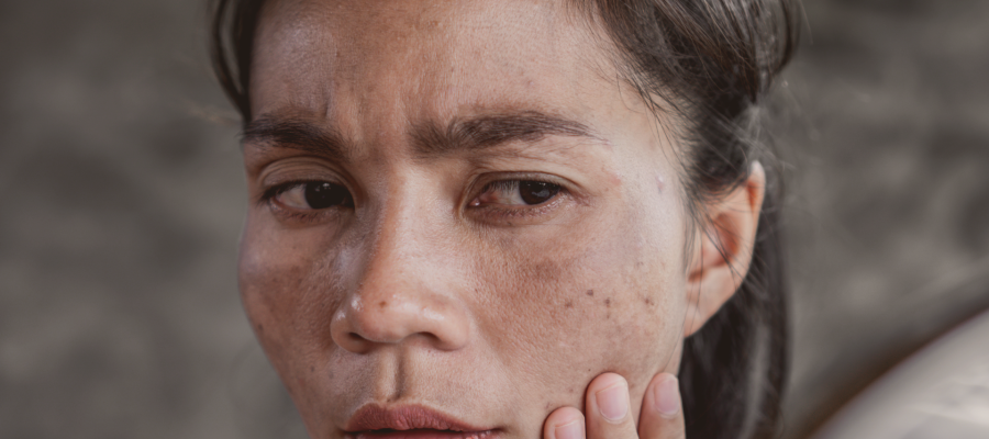 Melasma no Rosto: O Que É,